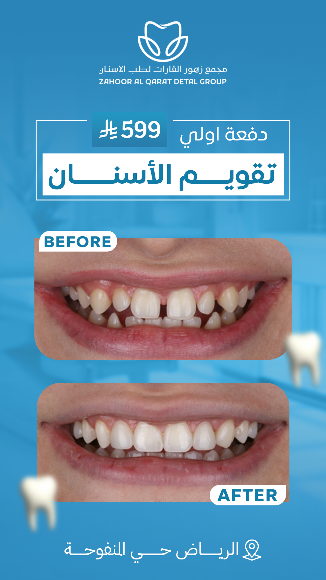 تقويم الأسنان 2